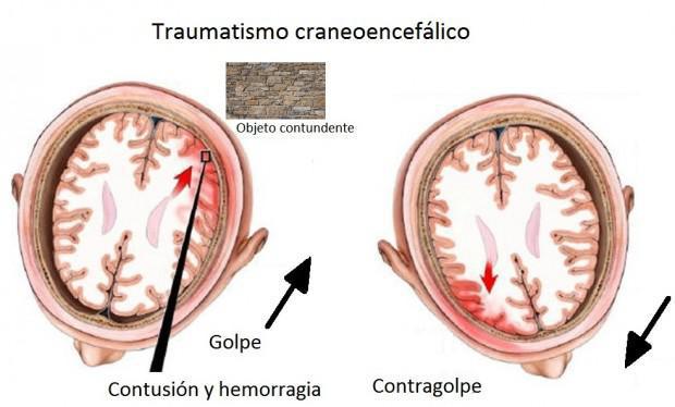 Rehabilitacion traumatismo craneoencefalico Rehabilitacion traumatismo craneoencefalico